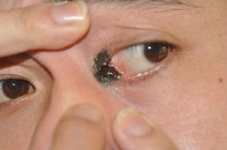 眼睑色素痣