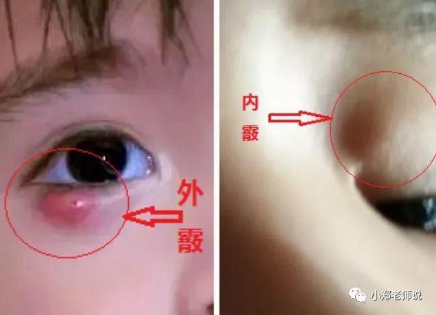 宝宝眼睛长疖子两种情况不同治疗一定要分清