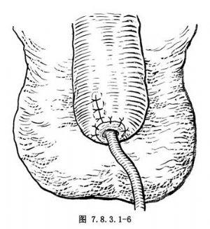 阴茎部分切除术