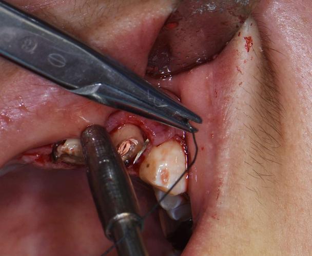 前牙冠延长术一例