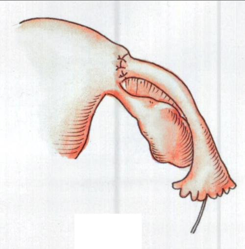 输卵管结扎术后复通术