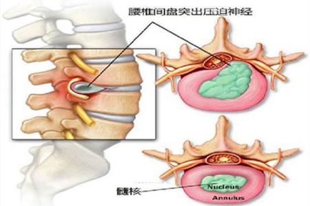 腰椎间盘突出症是什么又该如何预防
