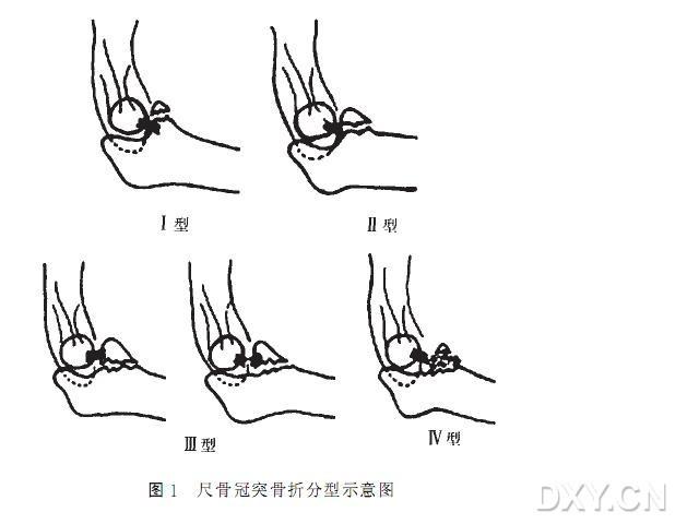 尺骨冠突骨折的分型及治疗
