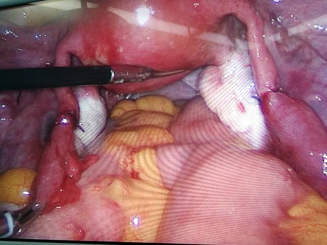首先找到输卵管陈旧性结扎疤痕的位置,并从腹腔镜显像中确定需要切除