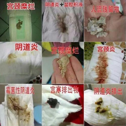 答:因为体寒引起血液流动速度缓慢,角质层过厚,器官功能下降,内膜脱落