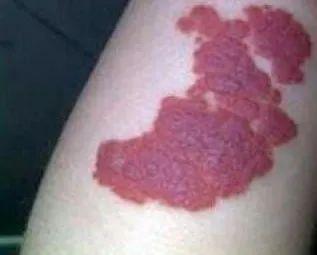 一般出生时已存在,最初颇似草莓状毛细血管瘤,但很快扩展至皮肤范围以