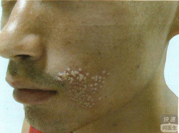 脓疱疮该如何饮食四大食疗调理脓疱疮