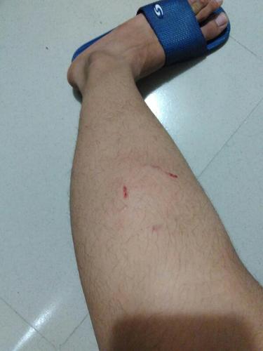 被狗咬伤了,但是没有伤口,有点淤青,表皮破了一点但没