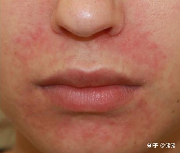 口周皮炎的症状表现及诱发因素