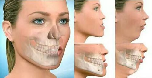 或者拔牙减少牙量后,完成是什么样就是什么样了,无法再进一步改变脸型