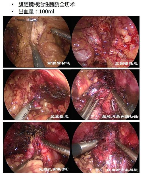腹腔镜膀胱癌根治术
