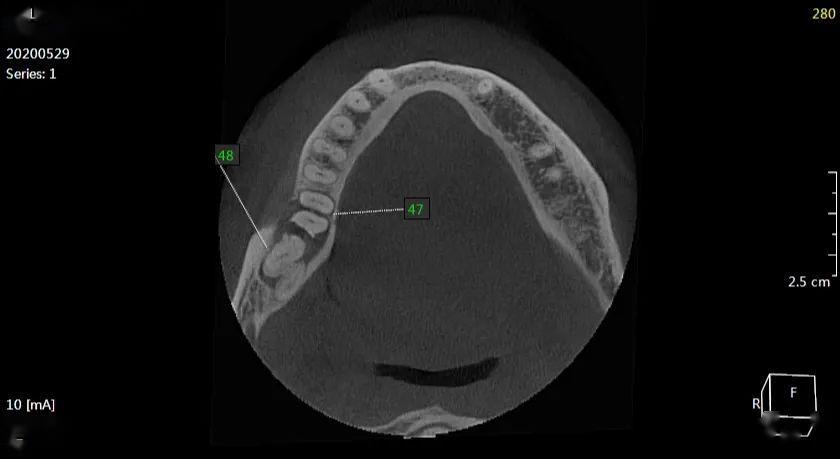 王xx20200529智齿cbct135xxxx6066