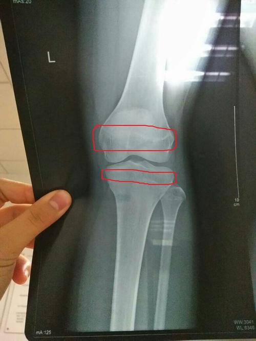 请问我今年15 怎么看x光上的骨骺线有没有闭合?