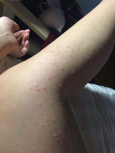 吃了新帕尔克的感冒药 过敏了 第一二是刚发的时候 现在不痒了 变成第