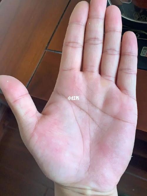 手诊1 双手颜色红润,玉柱线很好,有创业潜质. 大鱼际