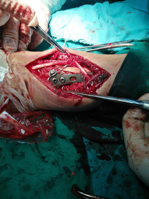 术后c型臂x光透视,骨折对位对线良好,桡腕关节面复位光滑,达解剖复位.