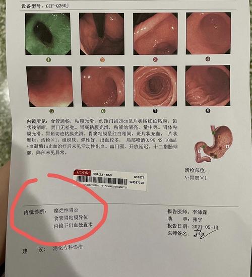 有同样胃镜诊断结果的吗?