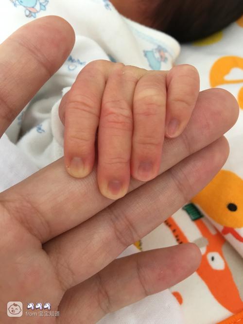 新生儿13天.指甲发紫.