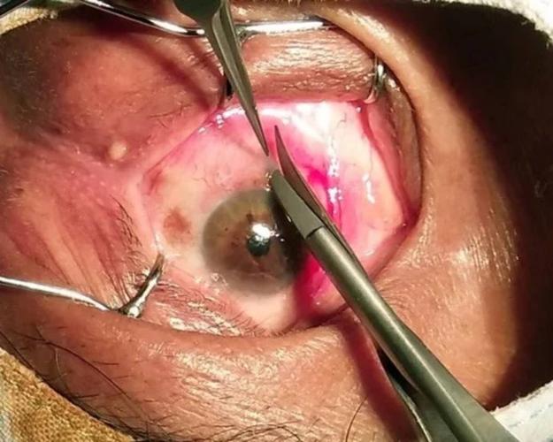 康燕可翼状胬肉手术全过程