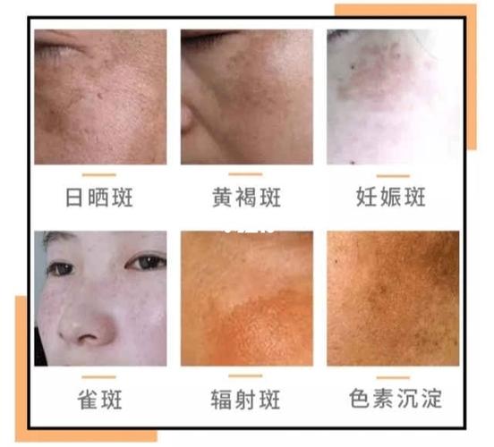 看看你属于哪种斑9494_晒斑_黄褐斑_防晒_物理防晒_运动_美妆