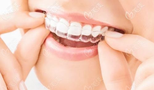 隐形牙套