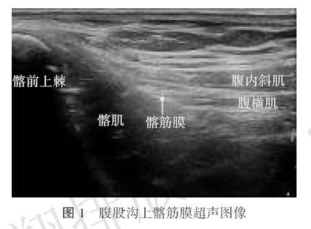 腹股沟上髂筋膜间隙阻滞与腰丛阻滞对直接前入路全髋