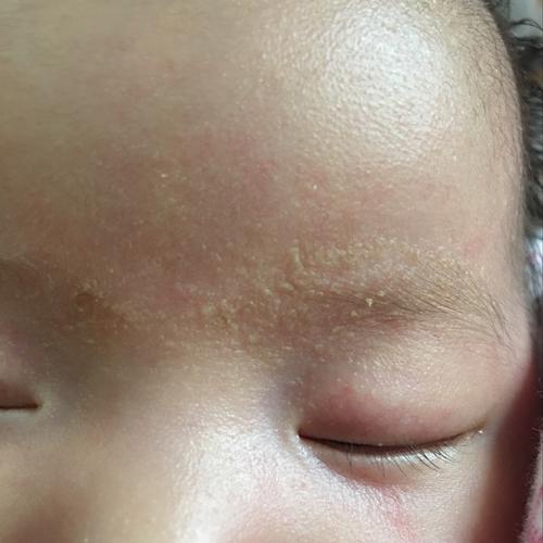 宝贝50天了,眉毛上还有好多眉痂不掉怎么回事,求宝妈支招
