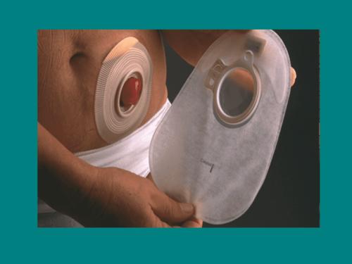 造口病人的护理ppt课件