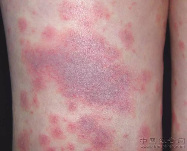 史上最全的皮肤病图谱,吐血整理!