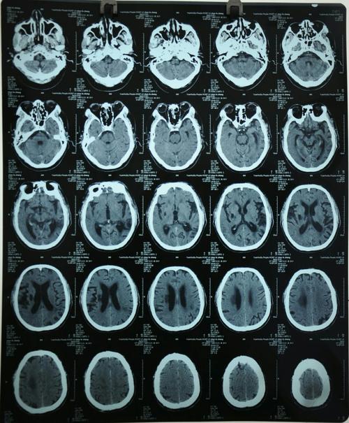 入院第一天脑部ct