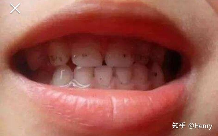 孩子牙上有小黑点,是怎么引起的?