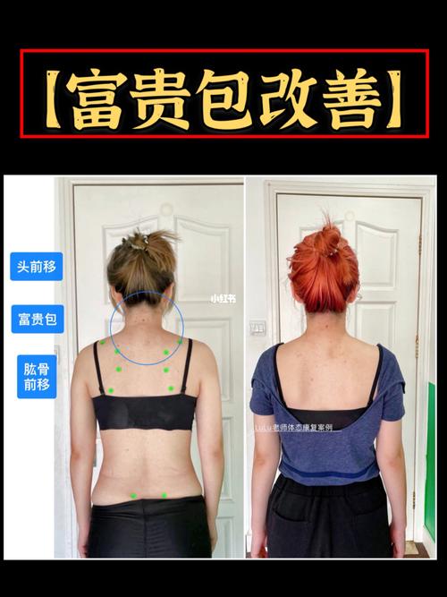 富贵包耸肩体态改善
