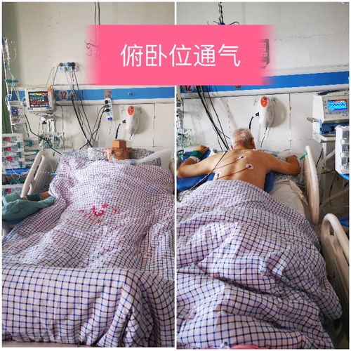 俯卧位通气——icu治疗法宝之一