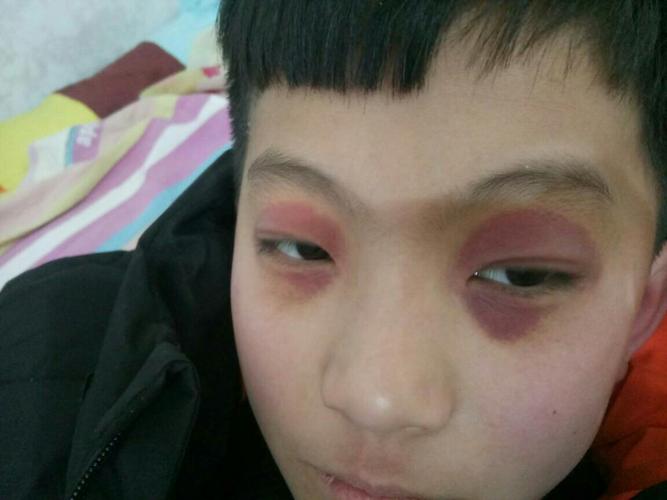 每次呕吐后眼睛皮周围会发红充血!是什么原因