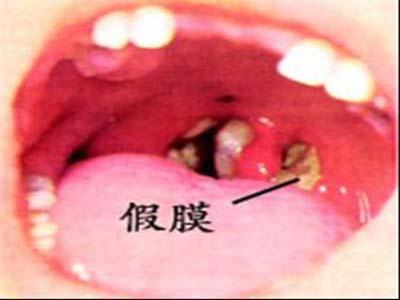 白喉如何治疗呢