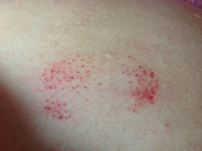 身上不知道怎么起这种血点 像刮痧一样 这是怎么回事