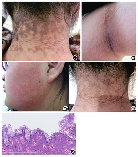 1b:腋下皮肤呈黑褐色,天鹅绒样增厚;1c:双颊部红斑上毛囊性丘疹;1d