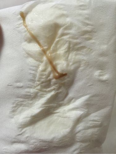 的子宫改变了原有的盆腔形态,二是由于体内促绒毛膜性腺激素的影响,是