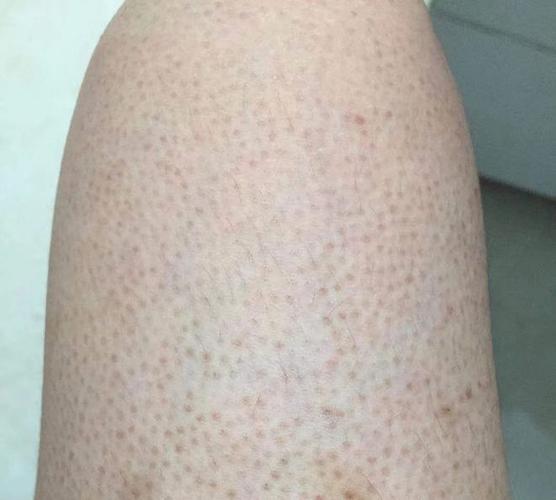 的角质增厚,毛囊被过厚的角质堵塞而引起的一种慢性毛囊角化性皮肤病