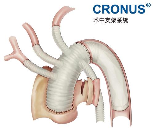 【心术live salon】第二期全弓置换 支架象鼻手术线上