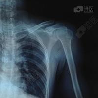 男24岁,肩关节脱位