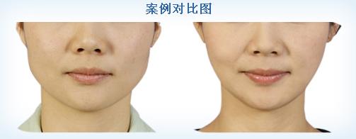一张图刺激你,双下巴不仅显胖还显老!