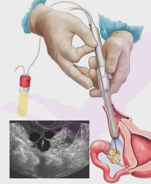 试管取卵需要经历哪些事?5张图告诉你!