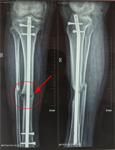 6个月一点骨痂没有的骨不连,治疗后长骨痂是什么体验?