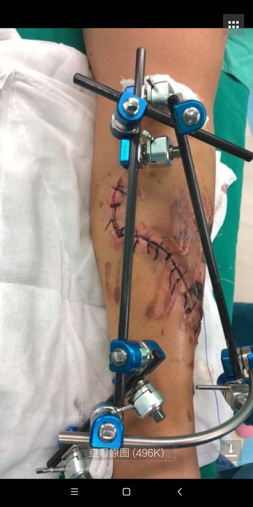 为车祸伤,今年11月18日入院,查体见:患者左小腿中段处严重开放性损伤