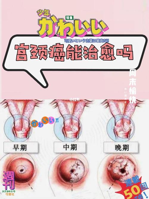 晚期宫颈癌就没有希望了吗还能活多久