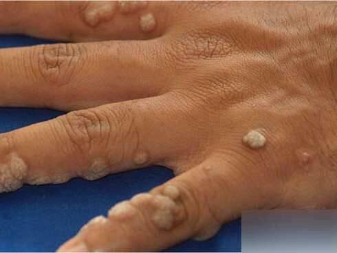 乳头瘤病毒图片