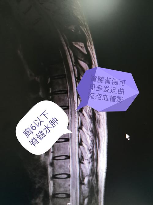 一例罕见的脊髓硬脊膜动静脉瘘