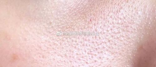 毛周角化主要与遗传等因素相关引起的角质化代谢异常疾病,常出现在