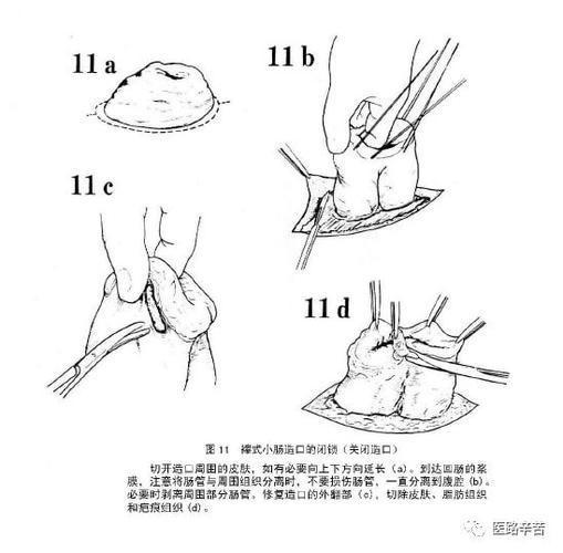 图解手术回肠及结肠造口术